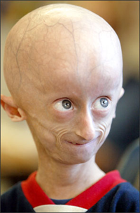 Progeriya