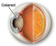 katarakta (göz xəstəliyi)